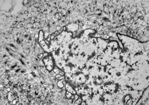 M,3m. | rhabdomyosarcoma in retented testis M,3m. | rhabdomyosarcoma in retented testis